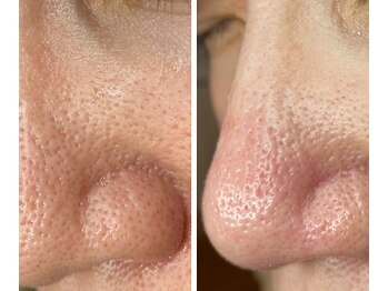 サイ(Sai)/before⇒after