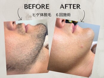 ワンアップ(One-up)/ヒゲ脱毛６回　before  after