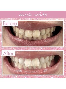 エクシアホワイトニング 武蔵小杉店/ビフォーアフター