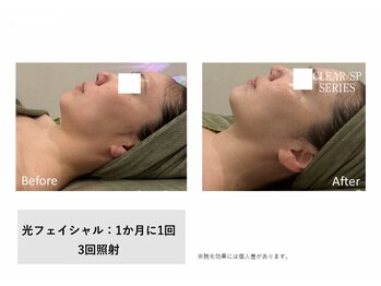 モイ(Moi’e)/ハリ・リフトアップ・くすみ