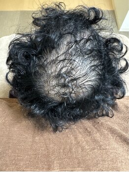 アマリージョヒラソル/Lit ヒト羊膜幹細胞