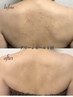 【ドイツ皮膚医師発祥グリーンピール】背中全体のブツブツ改善¥66000→