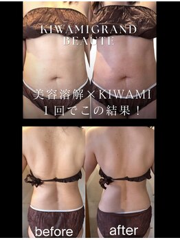 フランジパニ(FRANGIPANI)の写真/減量成功実績◎お客様のスタイルに合わせたご提案♪セル脂肪燃焼効果高い最新マシンで理想のボディラインへ
