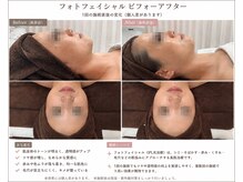 はだいろしずく/RF搭載光フェイシャル