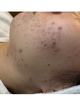 ルーチェ(LUCE)/ニキビケアはお任せください