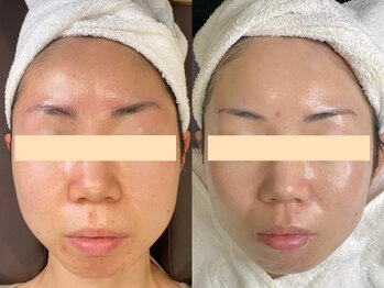 リラルボ(Relaluvo)/フェイシャルスキンケアwax脱毛