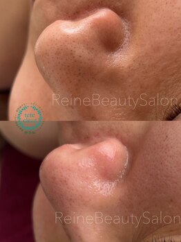 レーヌ(Reine)/毛穴エクストラクション