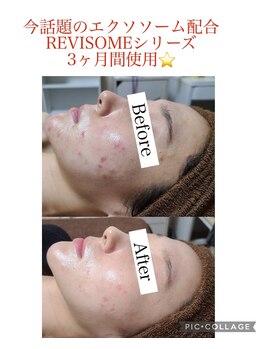 ナビ(NABI)/定期的なケアでここまで変わる！