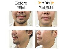 ネクサム(NEXUM)/【メンズ脱毛】Before/After