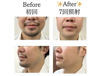 ネクサム(NEXUM)/【メンズ脱毛】Before/After