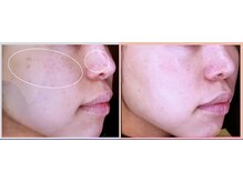 ボディアーキ 高知大丸店(BODY ARCHI)/お顔のbefore・after(6ヶ月)