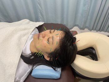 ふるさと治療院の写真/【歴20年の国家資格者による本格美容鍼】指圧マッサージとの組み合わせで相乗効果＆癒されてください♪