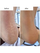 ケアプラス(care plus)/足裏角質ケア