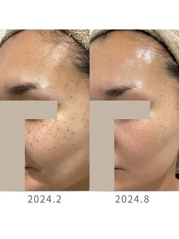 アズール(AZUL)/しみだけじゃない！