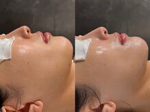 フロムミー 銀座本店(FROM ME)/3Xダーマジオ+コラージオ+LED