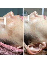 ルーチェエムベルシック(Luce.MBelChic)/シミとくすみのお悩み