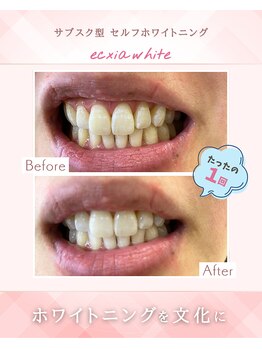 エクシアホワイトニング 浜松店/ホワイトニングビフォーアフター