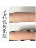 【二の腕のぶつぶつ・シミケア】リベルハーブピーリング(剥離あり)¥22,000