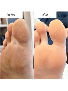 ケアプラス(care plus)/足裏角質ケア