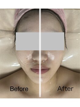 ハナ トータル ケア(Hana Total Care)/LDM水玉リフティングの効果