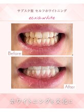 エクシアホワイトニング 浜松店/ホワイトニングビフォーアフター