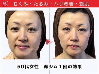 顔ジム 麻布店/50代女性 たるみ・むくみ改善