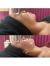 【ハーブピーリング/毛穴洗浄/小顔リフト】total beauty salon mayahime 大宮店/オンダリフト