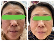 オリーブ(Olive)/お肌の代謝、血流を整えます。