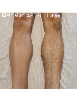 ルオント(LUONTO)/脱毛効果抜群！