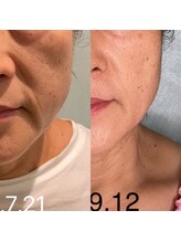 カイユウ(kaiyu)/3回集中ケア