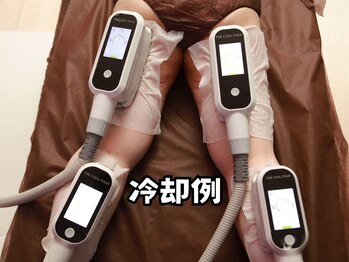 サニー(SUNNIE)/脂肪冷却装着例