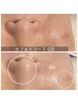 ペルラペティーユ(PERLA PETILLER)/フォト美顔：6回の施術効果