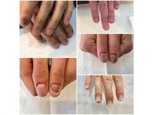 剥離などのダメージ爪でお悩みの方もご相談ください