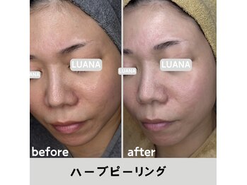 ルアナ 北谷店/ハーブピーリング 《沖縄/北谷》