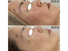 ミセル(MISEL2nd)/ニキビケア/肌質改善もお任せ♪