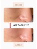 【フェイシャル 毛穴・黒ずみ】ポツポツ毛穴ざらつきを集中ケアでツル肌に