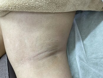 ナノハナ/鹿沼市全身脱毛美容室ナノハナ