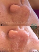 レーヌ(Reine)/毛穴エクストラクションフォトRF