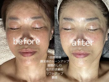 トータルビューティケア アヤ(Aya)/フラクセル　しわ　しみ