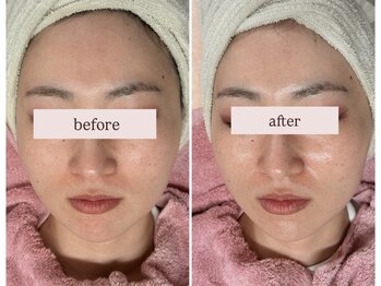 ピュルテ/水光ピーリングトリートメント