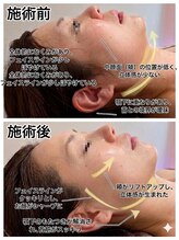 ミヨン ヨコハマ(Miyonne Yokohama)/LDM Aqua＋小顔ヘッドスパ上大岡