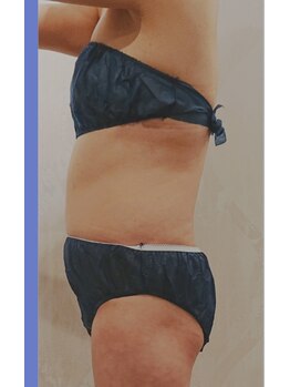 カルナボディ(Carna body.)/3回の痩身エステ変化☆施術前