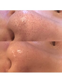 プルネ(Purune)/ハイドラ*黒ずみケア