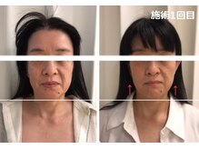 ナチュレアンドメディカ(Nature&Medica)/【たるみ改善】ウルトラリフト