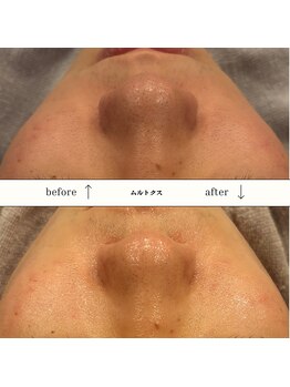 ビーエヌ エステティックアンドスパ(BN Esthetic&Spa)/メンズムルトクス