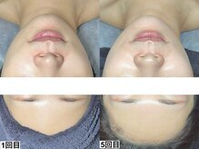 アンドミー 名古屋伏見(&me)/ララピール【艶肌/美白/くすみ】