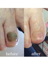 ドクターネイル爪革命 札幌大通店/症例紹介　肥厚爪