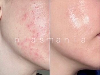 ボウ(Bou)/ニキビ改善