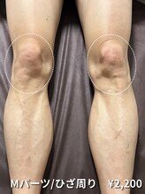 カナウ(KANAU)/【Mパーツ/脱毛】ひざ周り