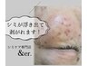 人気NO,1【満足度◎】抗酸化シミケア陶器肌コース ¥22,550→¥9,800